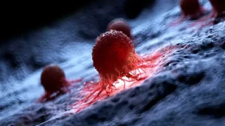 4 من كل 10 إصابات بالسرطان حول العالم كان يمكن تجنبها!